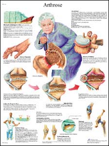 Lehrtafel - Arthrose Lehrtafel - Arthrose