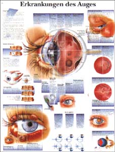 Lehrtafel - Erkrankungen des Auges Lehrtafel - Erkrankungen des Auges