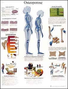 Lehrtafel - Osteoporose Lehrtafel - Osteoporose