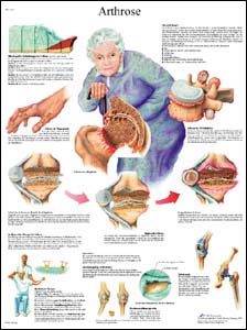 Lehrtafel - Arthrose