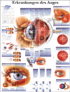 Lehrtafel - Erkrankungen des Auges